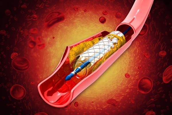 How An Echocardiogram Can Determine Whether You Need Angioplasty