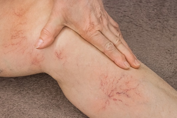 What Leg Spider Vein Treatment Can Do For You