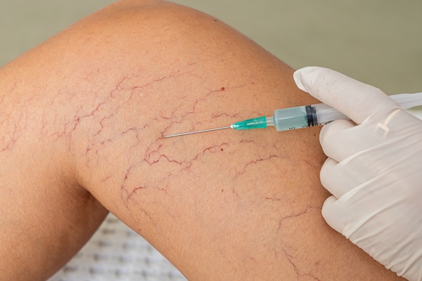 Frequently Asked Questions About Leg Spider Vein Treatment